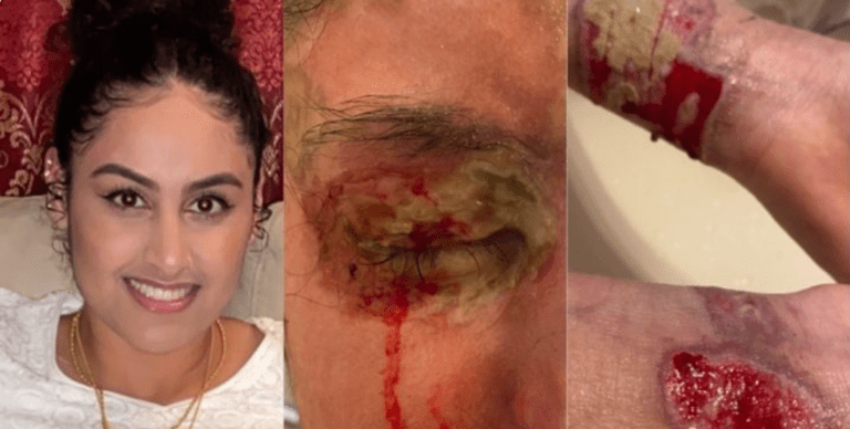 Legislator urges $50K reward to catch Hofstra student’s acid attacker