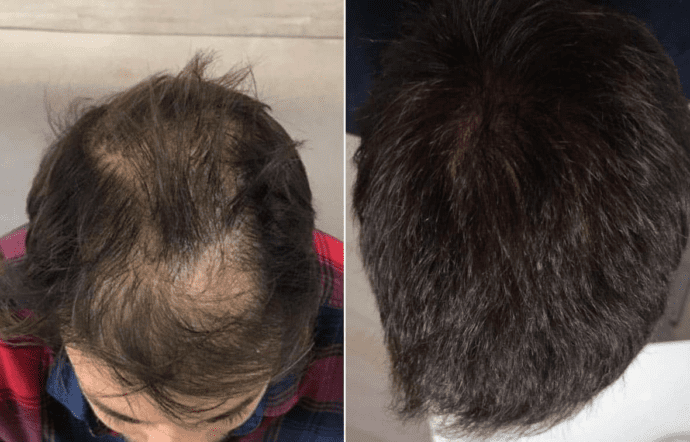 Folital before and after results